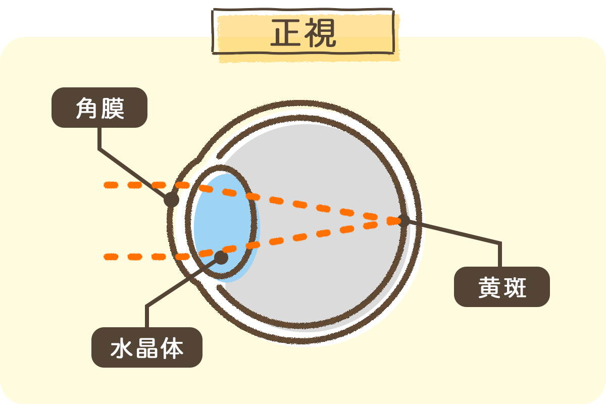 クーパービジョン