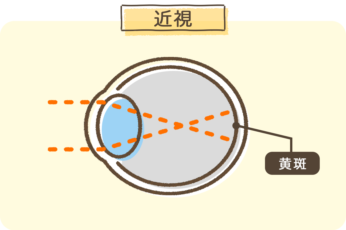 クーパービジョン